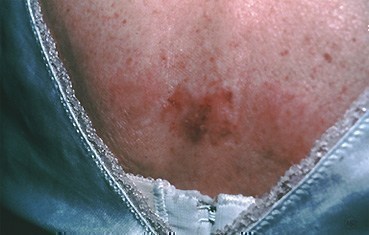 superficial-basal-cell-carcinoma-slide4
